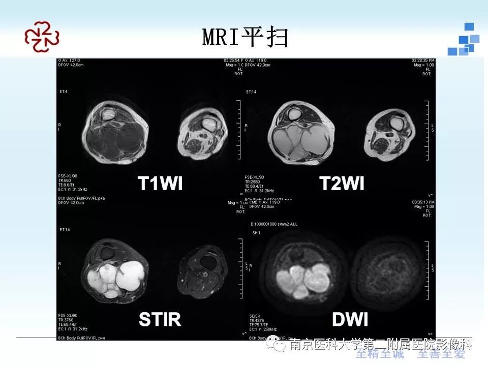 【PPT】脂肪肉瘤影像学表现
