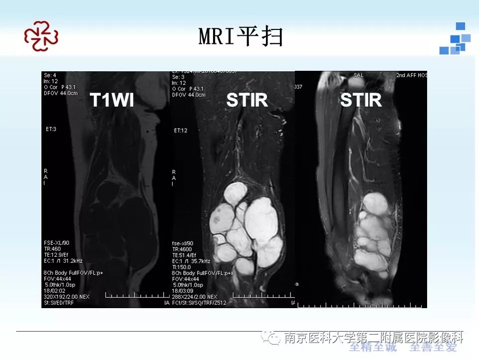 【PPT】脂肪肉瘤影像学表现