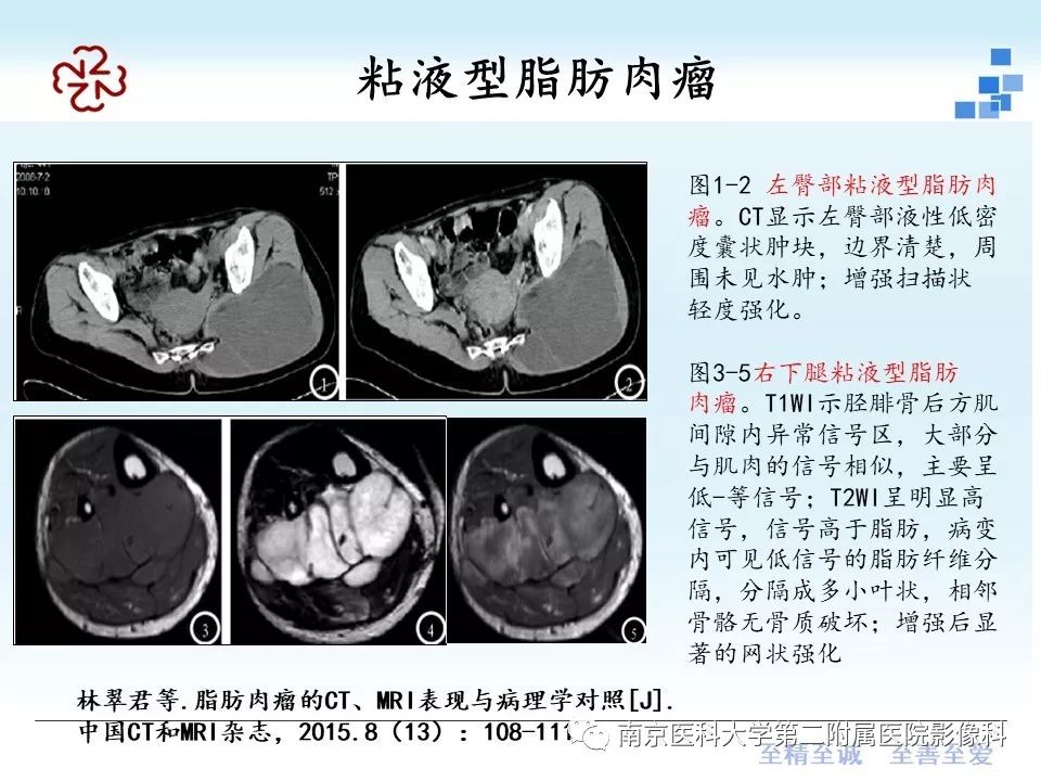 【PPT】脂肪肉瘤影像学表现