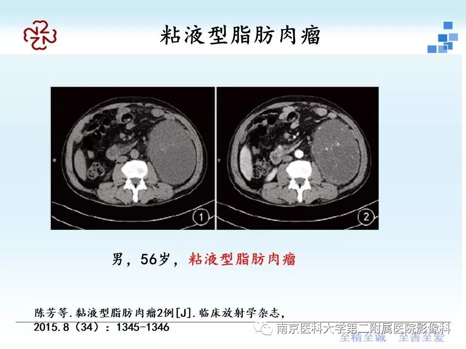 【PPT】脂肪肉瘤影像学表现