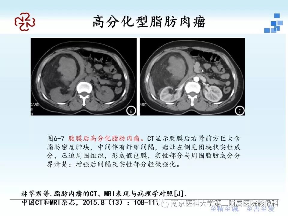 【PPT】脂肪肉瘤影像学表现