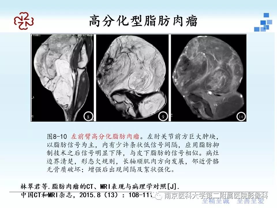 【PPT】脂肪肉瘤影像学表现