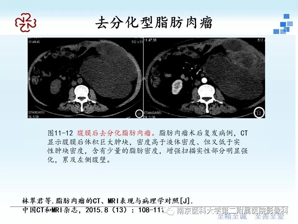 【PPT】脂肪肉瘤影像学表现