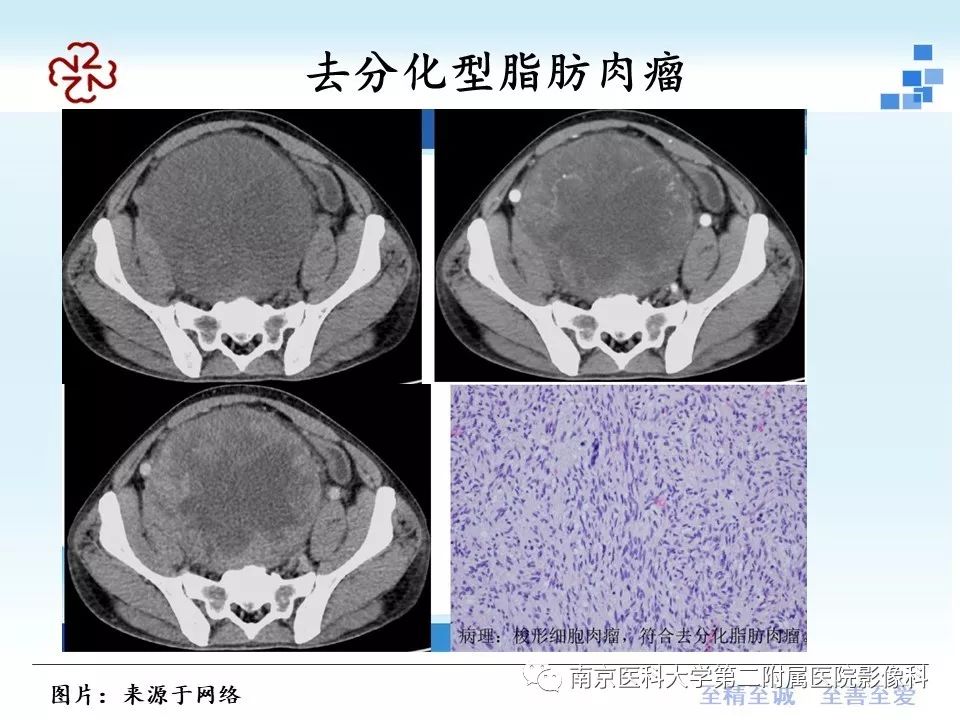 【PPT】脂肪肉瘤影像学表现