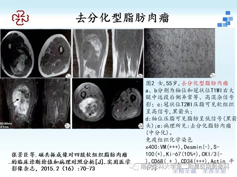 【PPT】脂肪肉瘤影像学表现