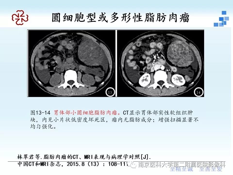【PPT】脂肪肉瘤影像学表现