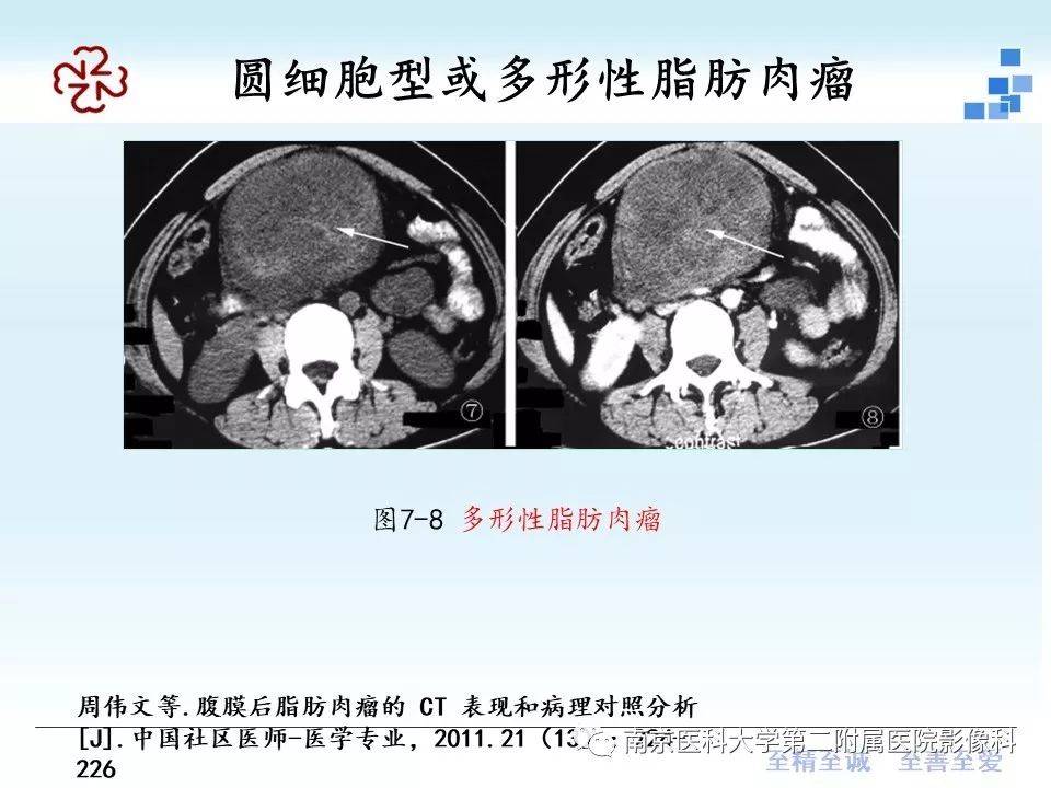 【PPT】脂肪肉瘤影像学表现