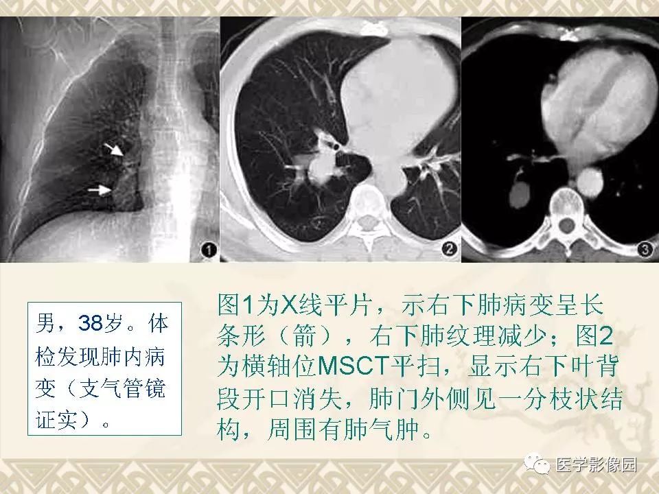 【PPT】先天性支气管闭锁的影像学诊断