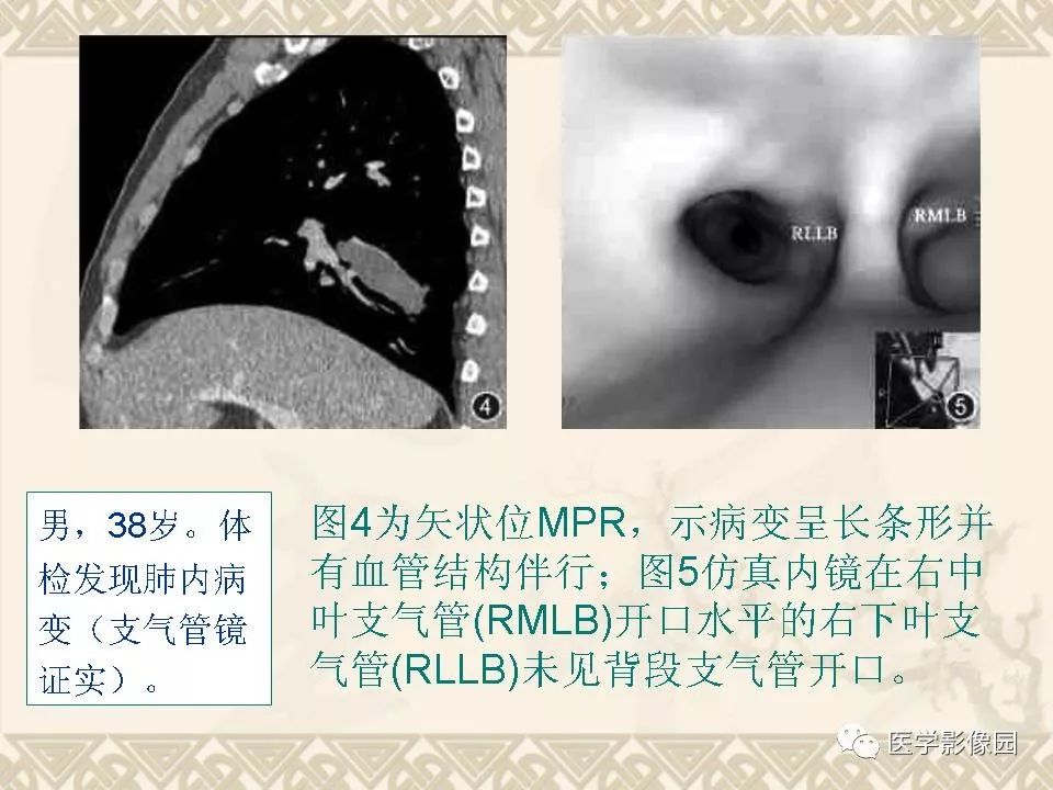 【PPT】先天性支气管闭锁的影像学诊断