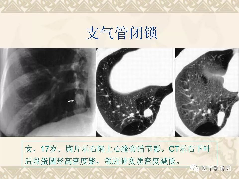 【PPT】先天性支气管闭锁的影像学诊断