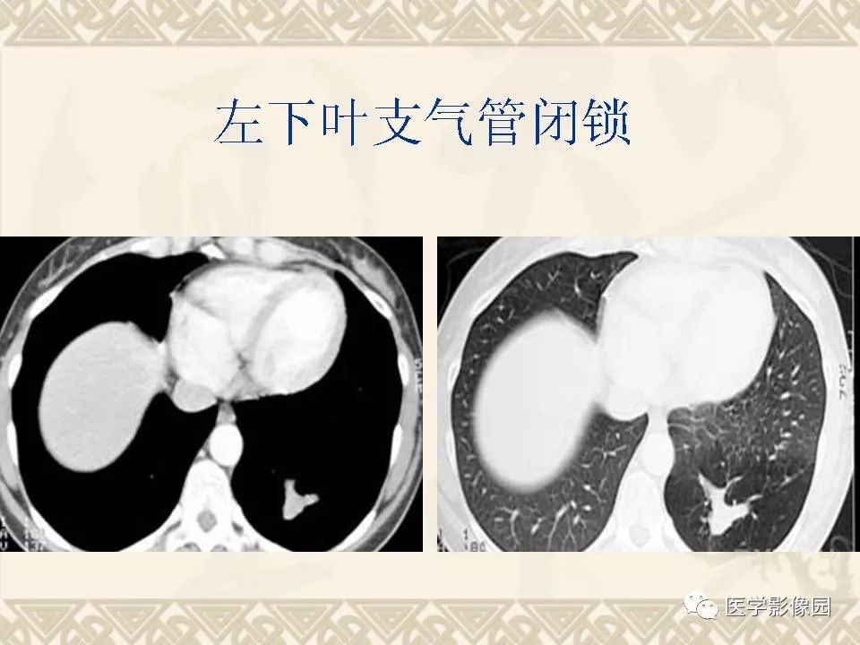 【PPT】先天性支气管闭锁的影像学诊断