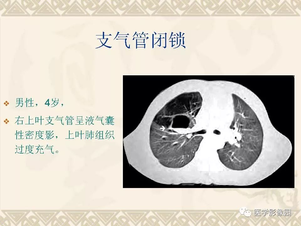 【PPT】先天性支气管闭锁的影像学诊断