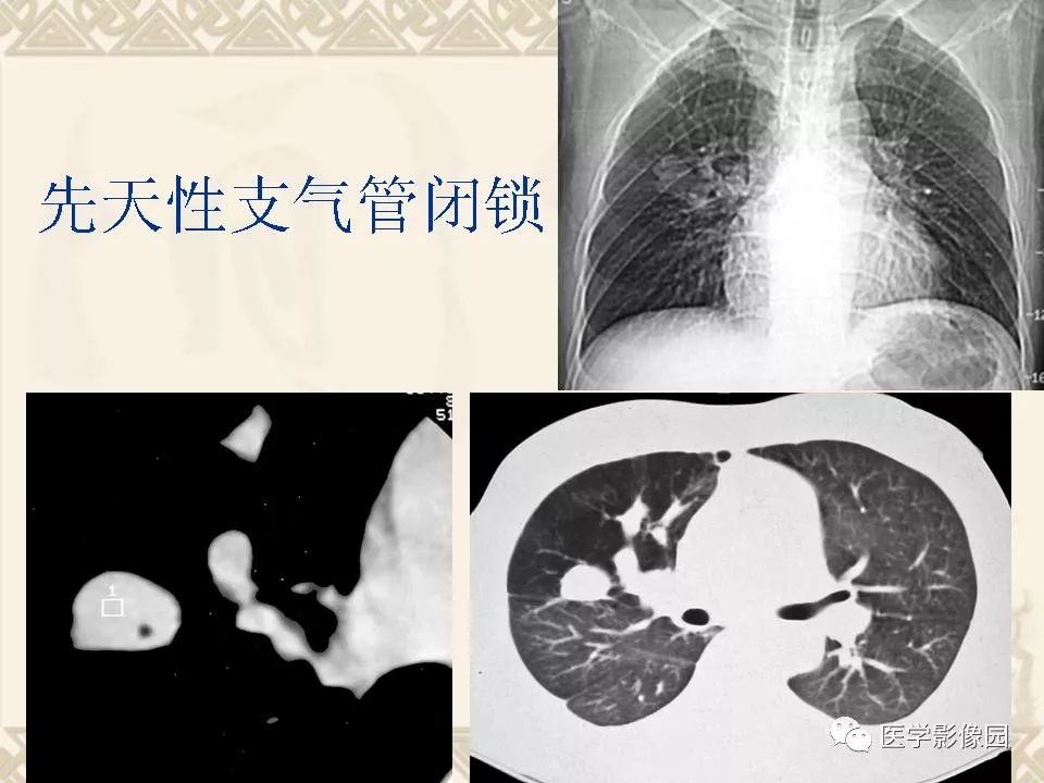 【PPT】先天性支气管闭锁的影像学诊断