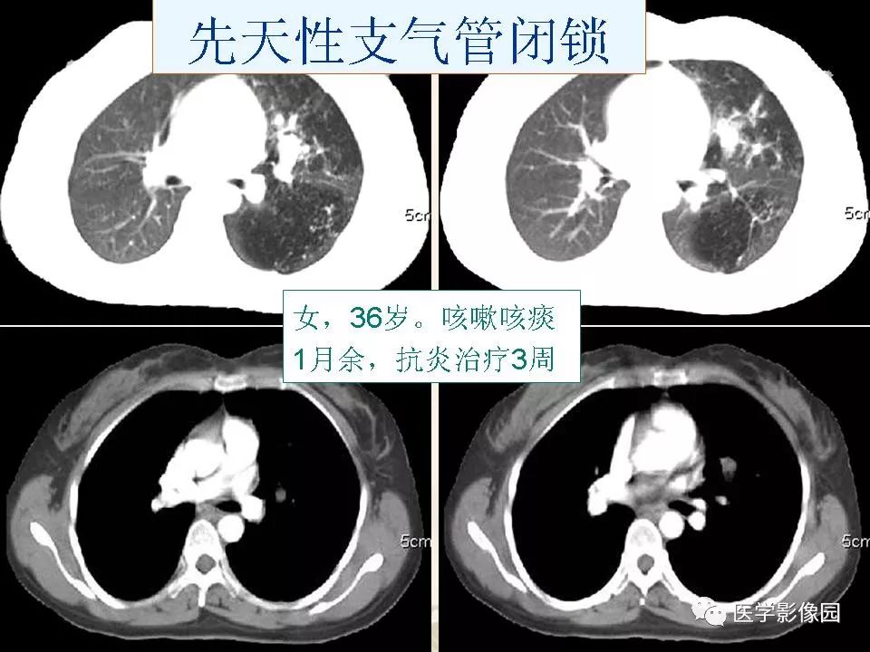【PPT】先天性支气管闭锁的影像学诊断