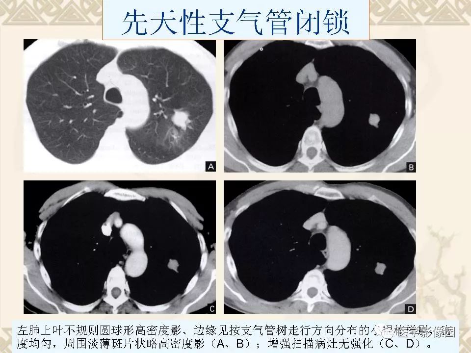 【PPT】先天性支气管闭锁的影像学诊断