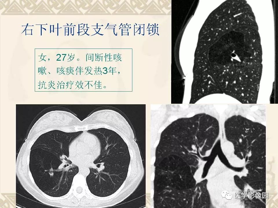 【PPT】先天性支气管闭锁的影像学诊断