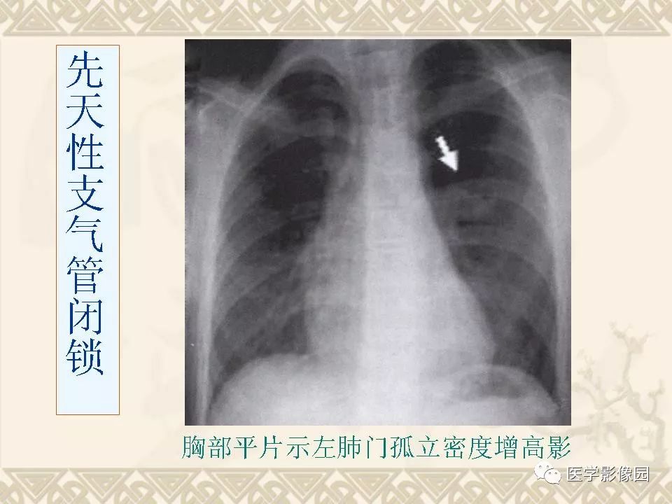 【PPT】先天性支气管闭锁的影像学诊断