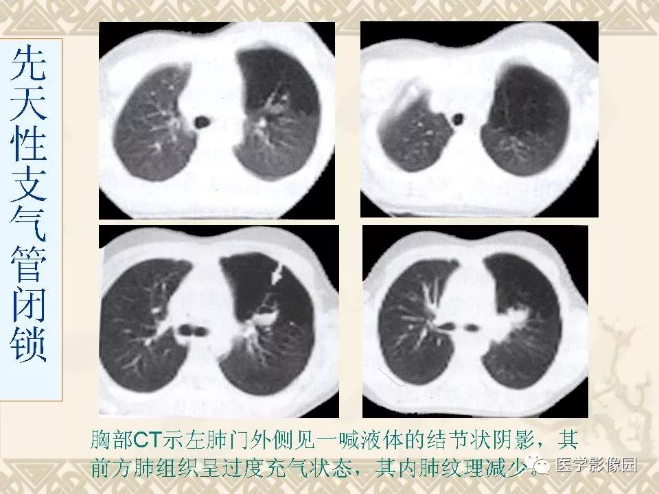 【PPT】先天性支气管闭锁的影像学诊断