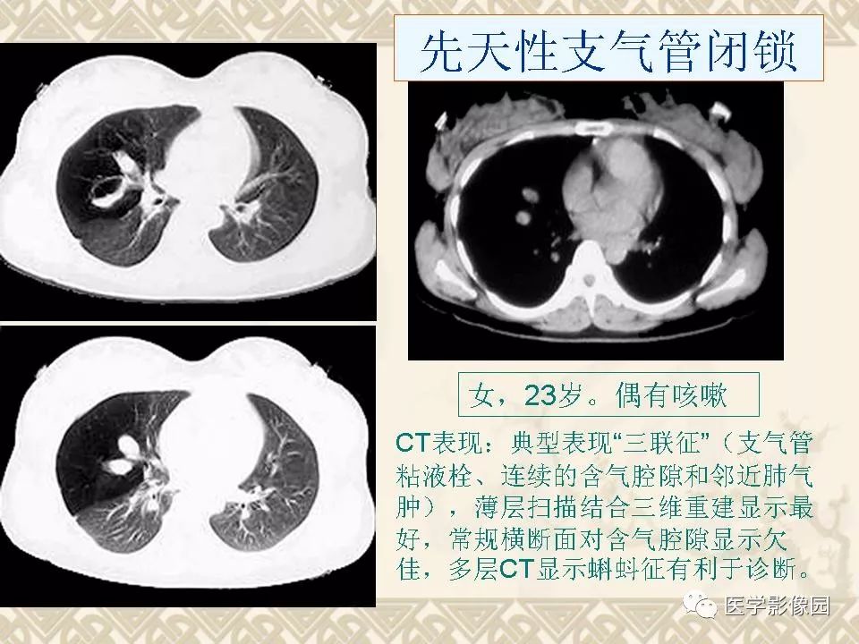 【PPT】先天性支气管闭锁的影像学诊断