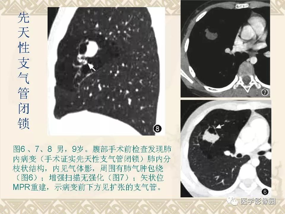 【PPT】先天性支气管闭锁的影像学诊断