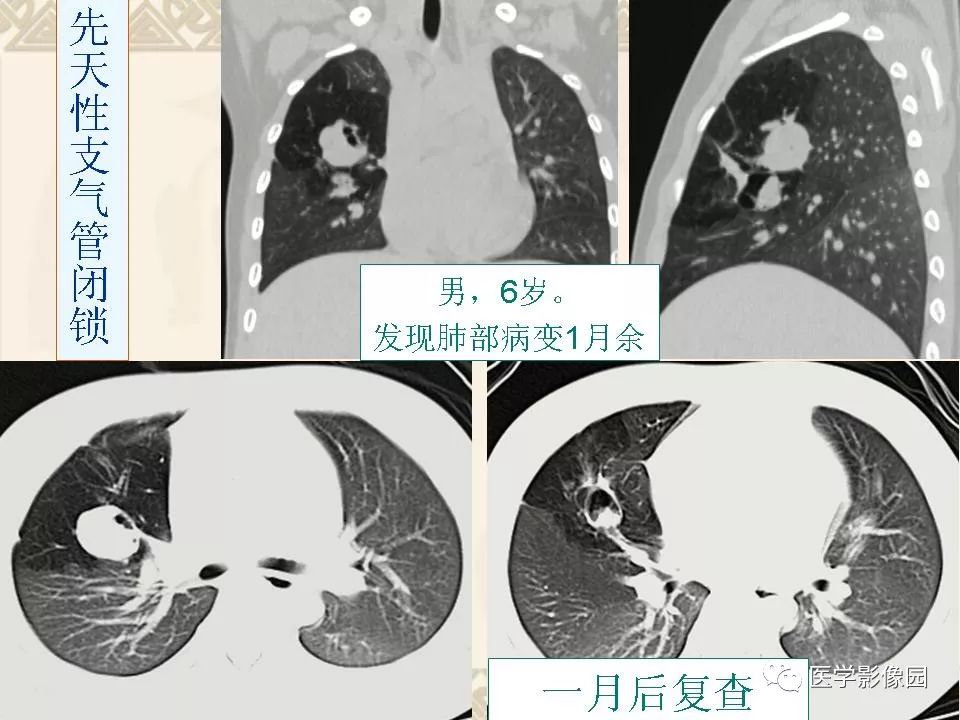 【PPT】先天性支气管闭锁的影像学诊断