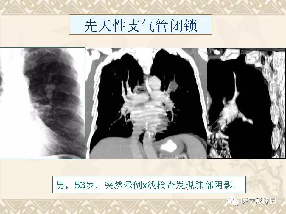 【PPT】先天性支气管闭锁的影像学诊断