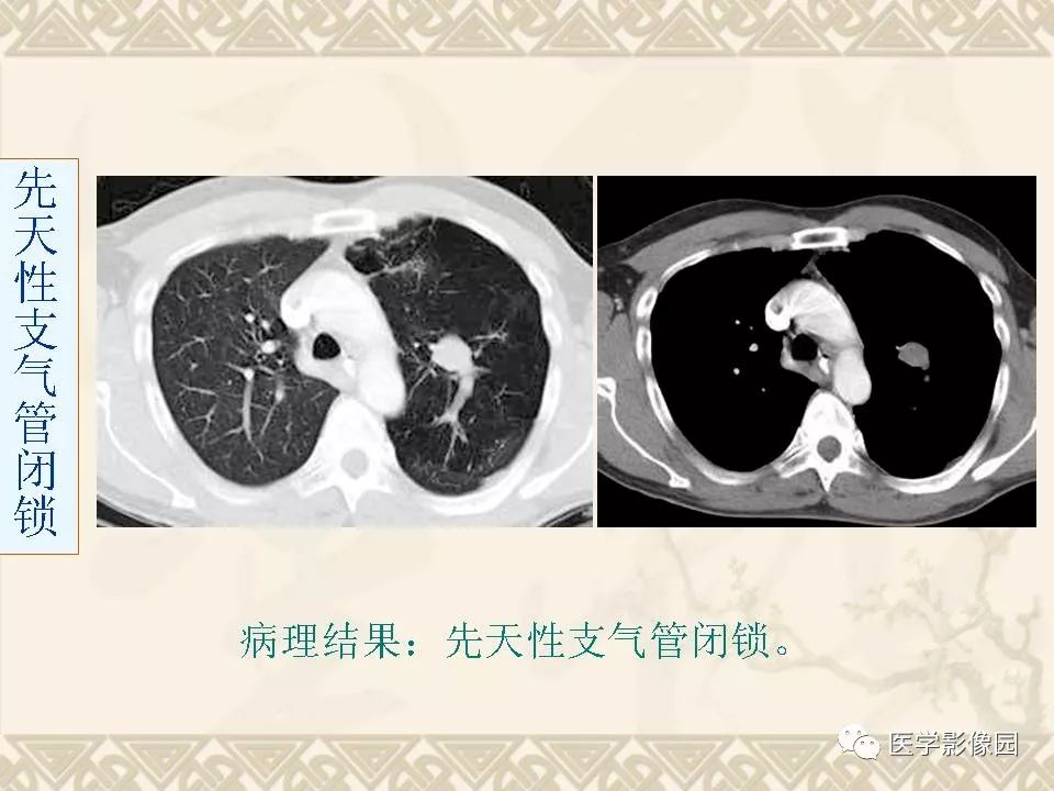 【PPT】先天性支气管闭锁的影像学诊断