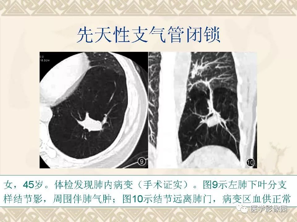 【PPT】先天性支气管闭锁的影像学诊断
