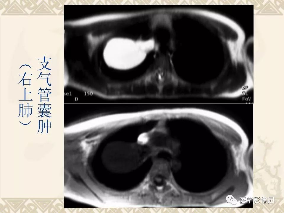 【PPT】先天性支气管闭锁的影像学诊断