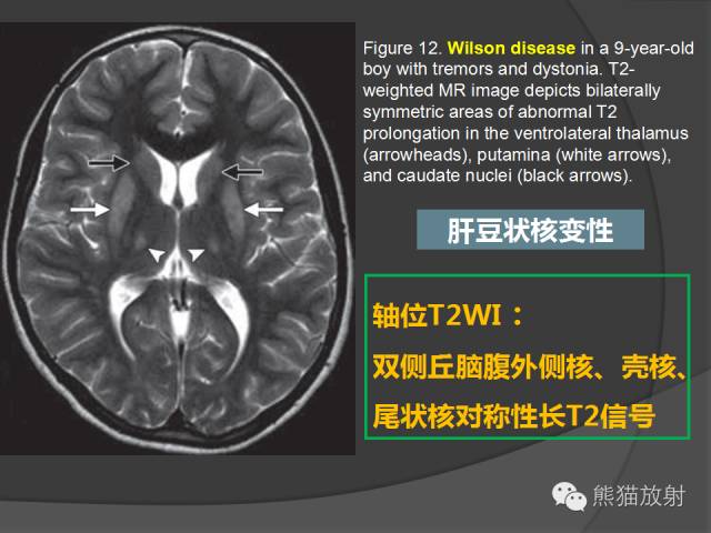 肝豆状核变性(Wilson病) 肝豆状核变性(Wilson病)
