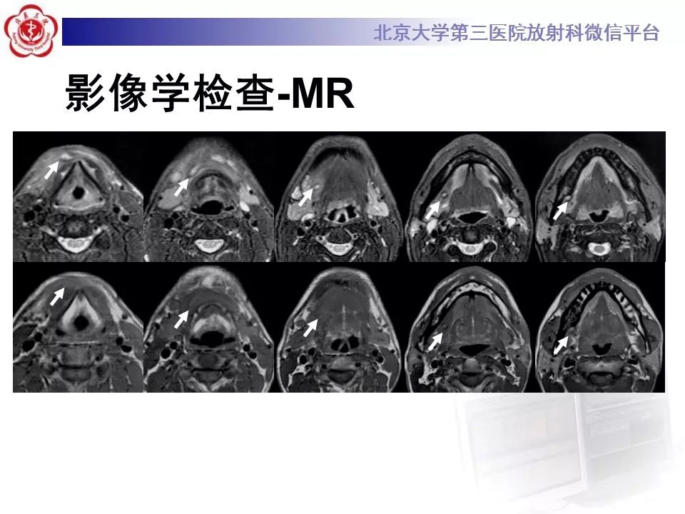 【病例】牙源性皮肤瘘1例CT及MR影像表现
