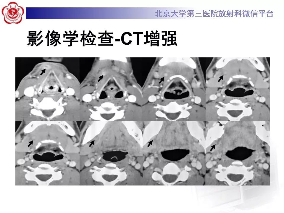 【病例】牙源性皮肤瘘1例CT及MR影像表现