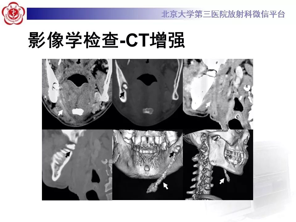 【病例】牙源性皮肤瘘1例CT及MR影像表现