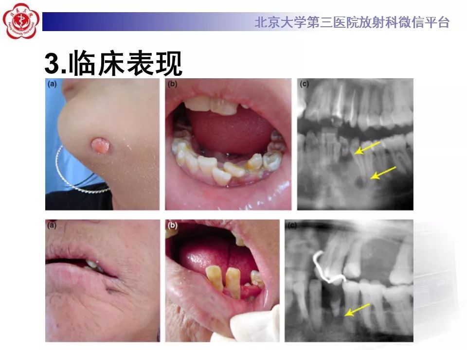 【病例】牙源性皮肤瘘1例CT及MR影像表现