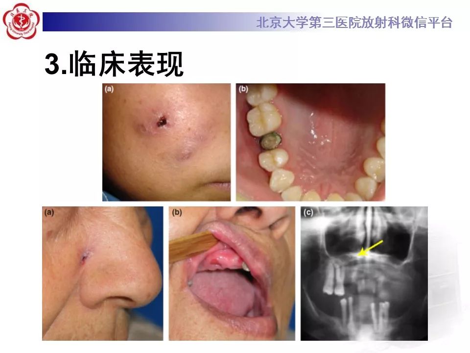 【病例】牙源性皮肤瘘1例CT及MR影像表现