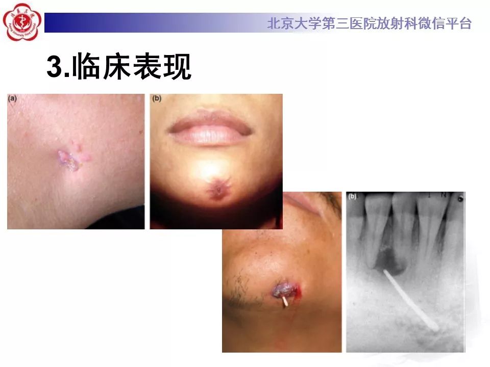 【病例】牙源性皮肤瘘1例CT及MR影像表现