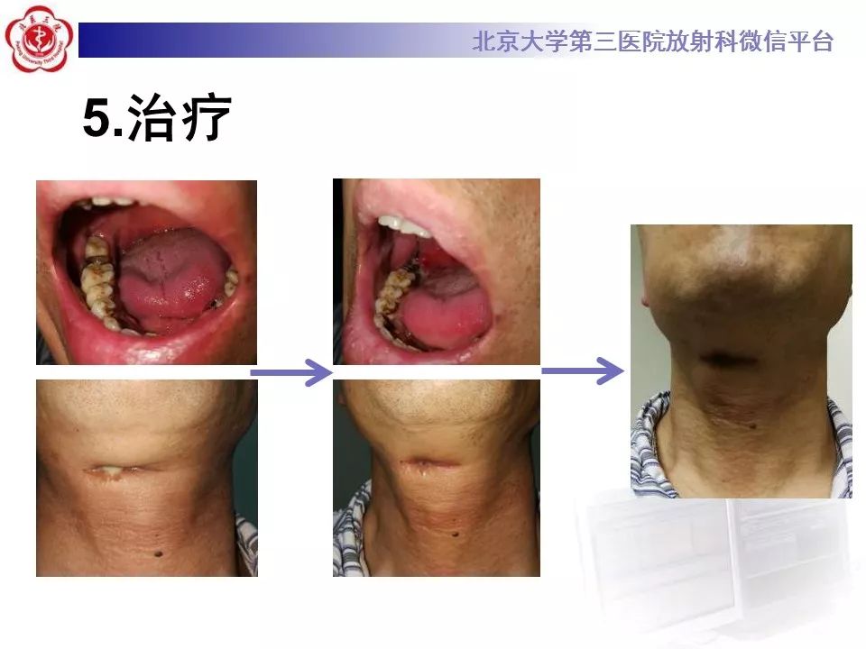【病例】牙源性皮肤瘘1例CT及MR影像表现