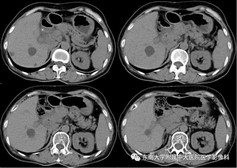 【病例】胰腺结核1例CT影像表现