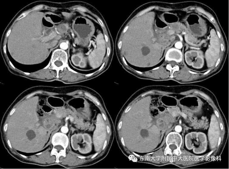 【病例】胰腺结核1例CT影像表现