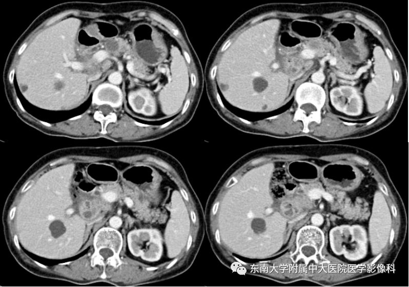 【病例】胰腺结核1例CT影像表现