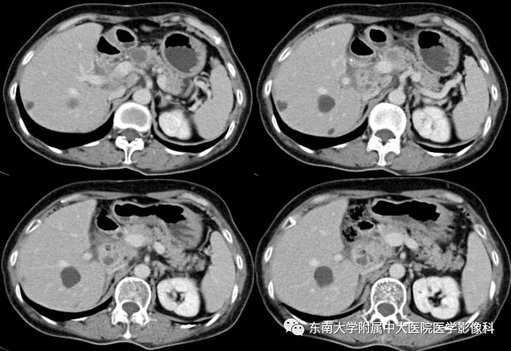 【病例】胰腺结核1例CT影像表现