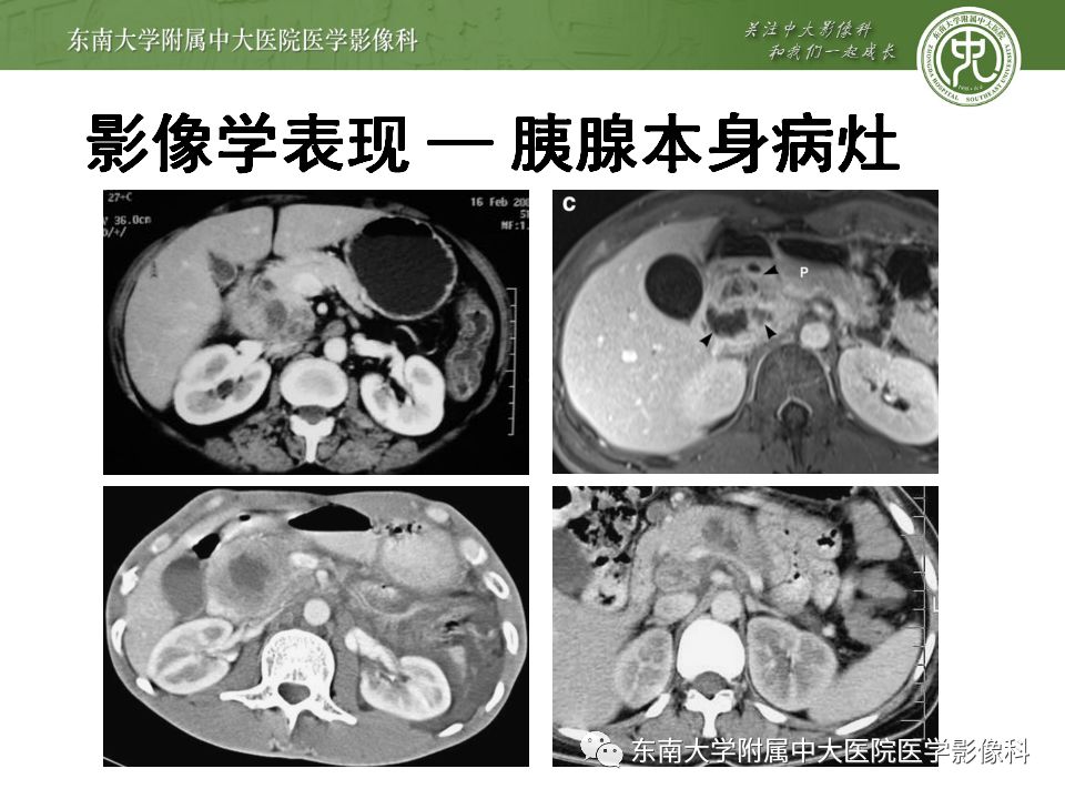 【病例】胰腺结核1例CT影像表现