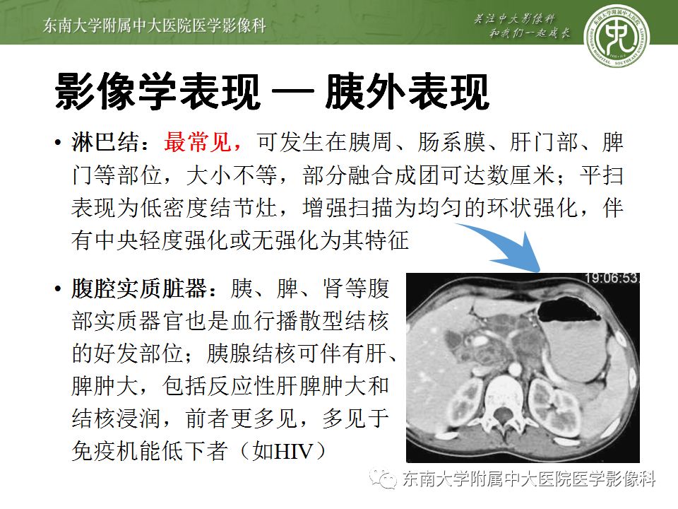 【病例】胰腺结核1例CT影像表现