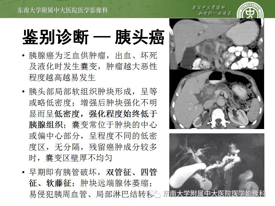 【病例】胰腺结核1例CT影像表现
