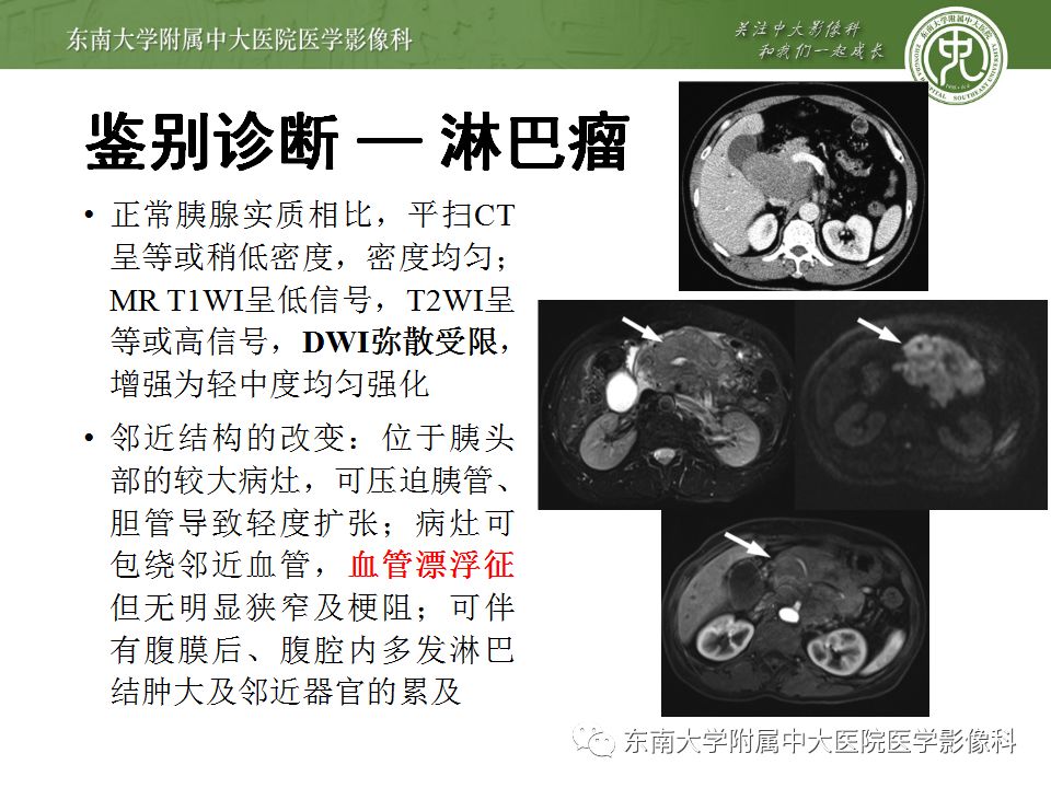 【病例】胰腺结核1例CT影像表现