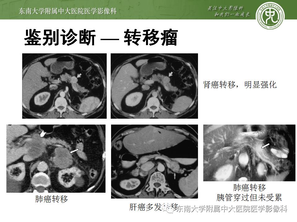 【病例】胰腺结核1例CT影像表现