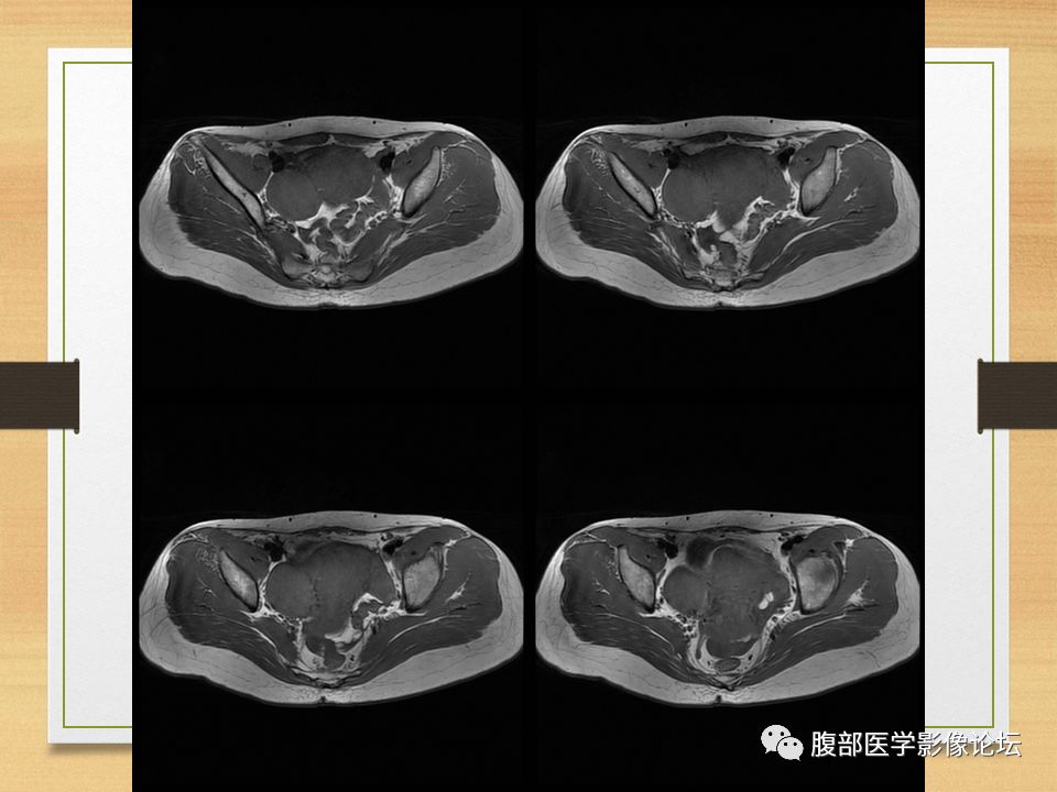 【病例】右侧卵巢卵泡膜纤维瘤1例MR