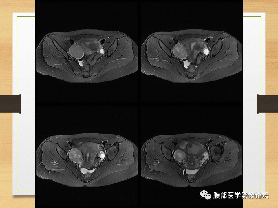 【病例】右侧卵巢卵泡膜纤维瘤1例MR
