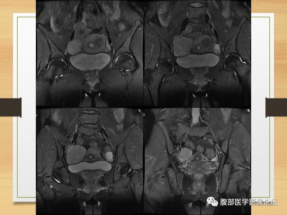 【病例】右侧卵巢卵泡膜纤维瘤1例MR