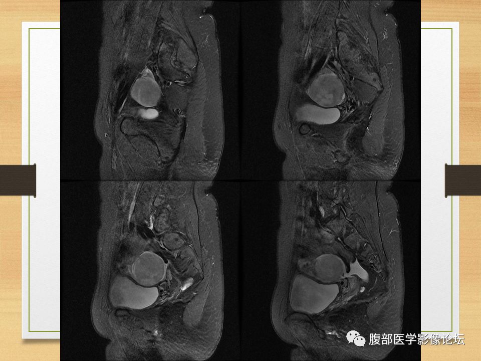 【病例】右侧卵巢卵泡膜纤维瘤1例MR